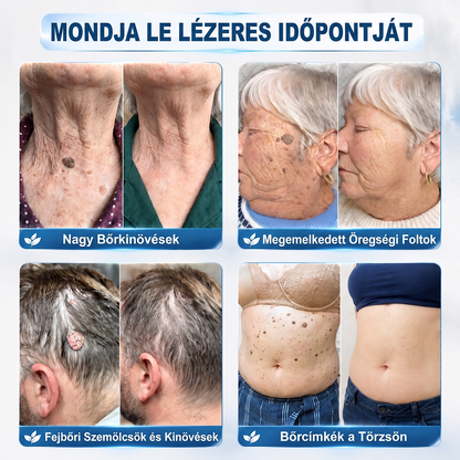 💕Hivatalos Márkabolt | 🚢🚢 Hiskin® 7 napos Szemölcseltávolító Roll-on Ápoló Folyadék (Fájdalommentes rollerball technológia, hegek nélkül) 🐬