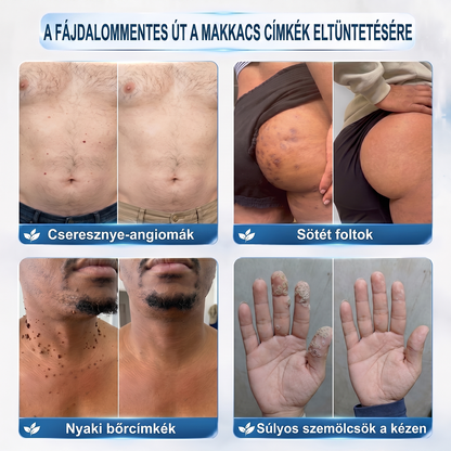 💕Hivatalos Márkabolt | 🚢🚢 Hiskin® 7 napos Szemölcseltávolító Roll-on Ápoló Folyadék (Fájdalommentes rollerball technológia, hegek nélkül) 🐬