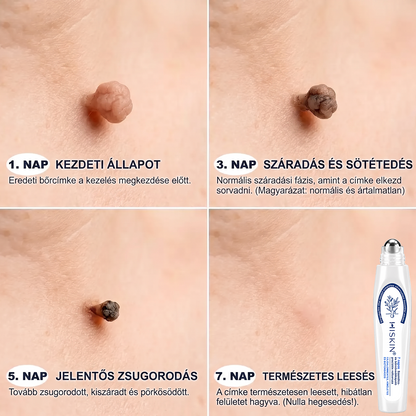 💕Hivatalos Márkabolt | 🚢🚢 Hiskin® 7 napos Szemölcseltávolító Roll-on Ápoló Folyadék (Fájdalommentes rollerball technológia, hegek nélkül) 🐬